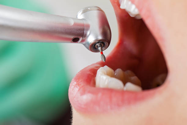 Best Emergency Root Canal Treatment in Buckingham, FL